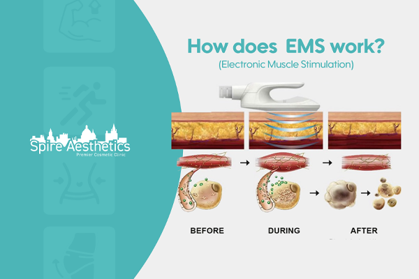 EMS treatment for post pregnancy weight loss treatment Kingston upon Thames