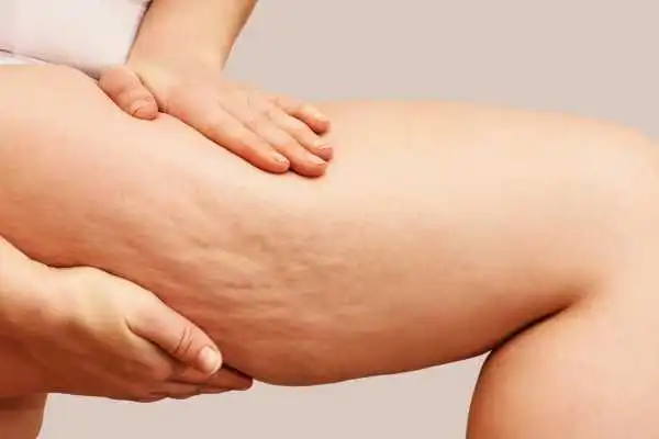 Image of woman showing leg with cellulite Kingston upon Thames