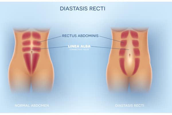 What Non-Surgical Options Are Available for Diastasis Recti Kingston upon Thames?