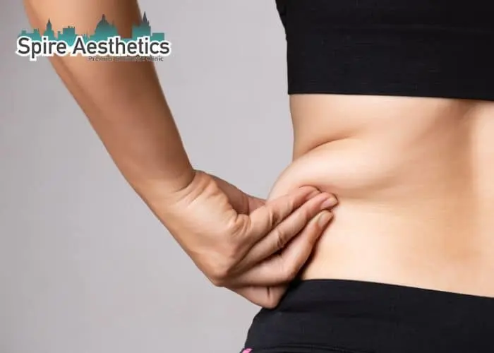 Image of woman pinching fat on their hips Kingston upon Thames. Fat Freezing treatment