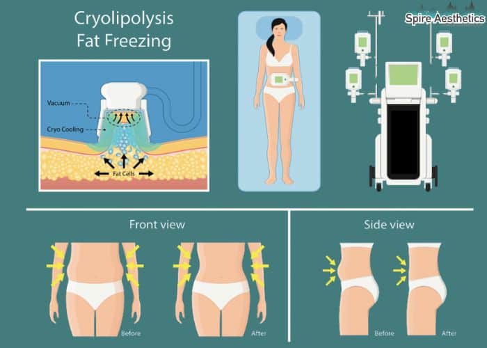 Image of diet and fat freezing combined for best results for Spire Aesthetics Kingston upon Thames