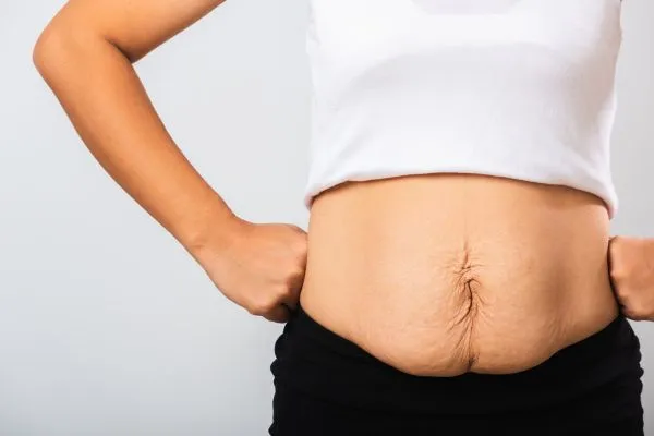 Image of a woman's stomach after weight loss with sagging skin following a gastric band Kingston upon Thames