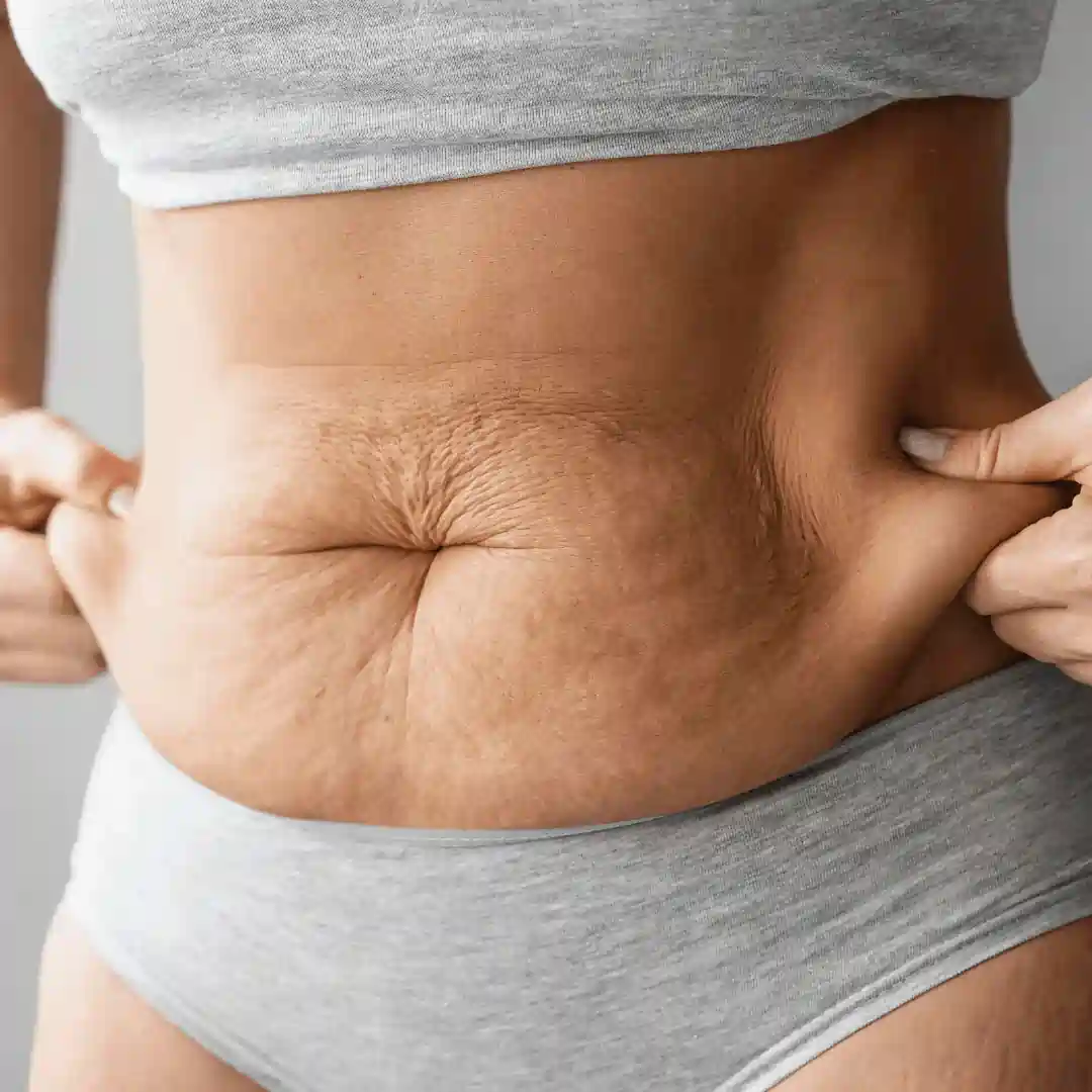 Is It Normal to Have Loose Skin After Pregnancy Kingston upon Thames?