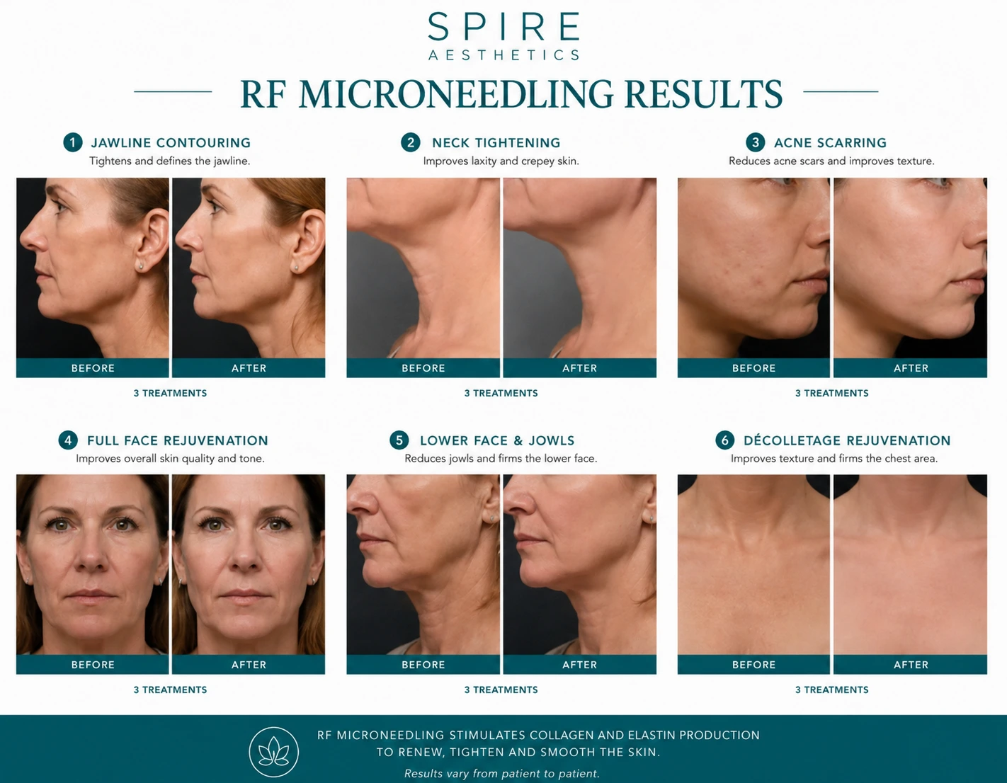RF Microneedling Skin tightening Kingston upon Thames results