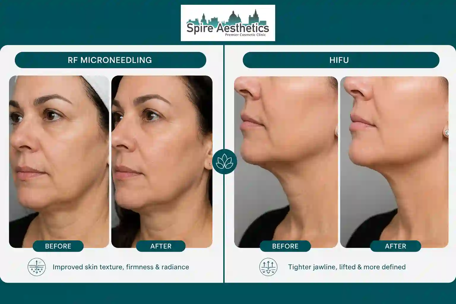 Can RF Microneedling and HIFU Be Combined Kingston upon Thames?