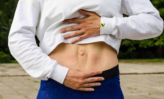 When Could Diastasis Recti Be the Missing Piece of the Puzzle Kingston upon Thames?