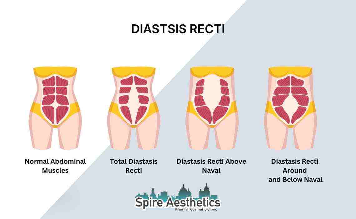 Is Non-Surgical Diastasis Recti Treatment Right for You? Common Concerns Answered Kingston upon Thames